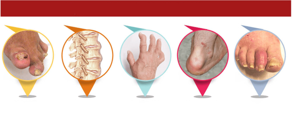 typy psoriatickej artritídy