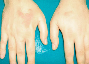 Lokalizácia ochorenia na ruky
